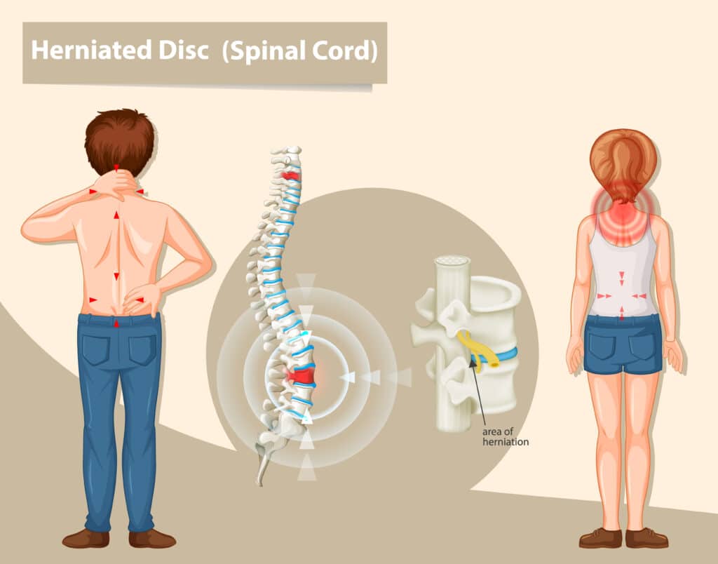 Best Slip Disc Treatment Without Surgery in Mumbai,
