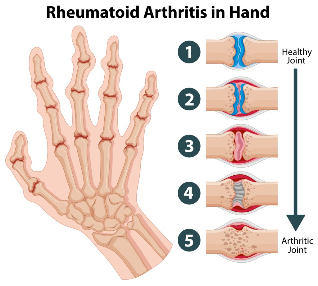 How Can Vitamin D Help Relieve Your Rheumatoid Arthritis?