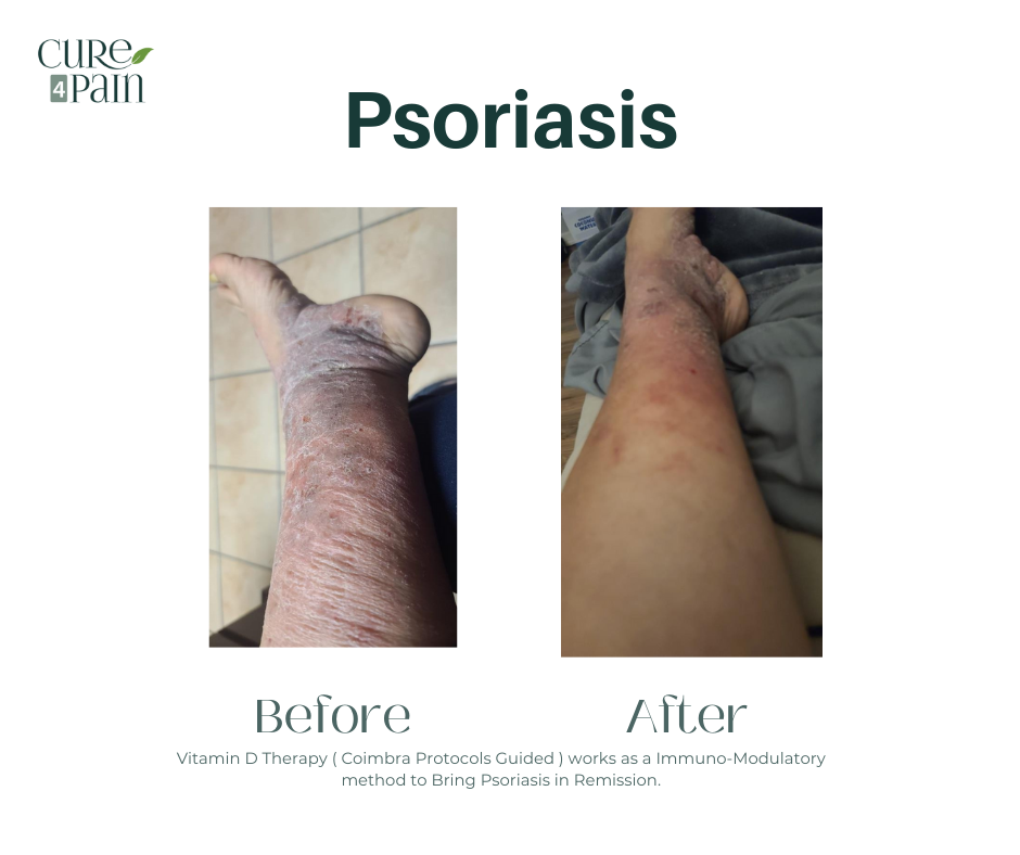 Case Study: Psoriasis in Sustained Remission with Coimbra Protocol–Guided Vitamin D Therapy