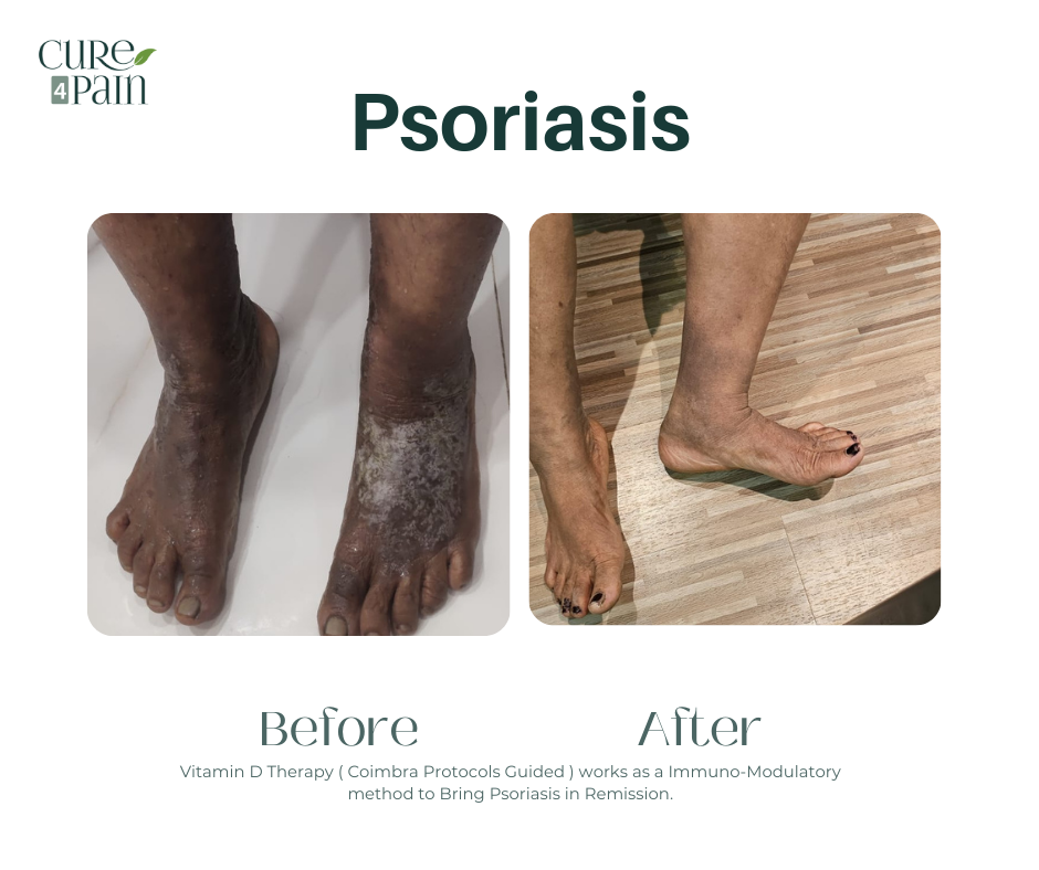 Psoriasis Treatment in Mumbai – Cure4Pain Integrative Approach