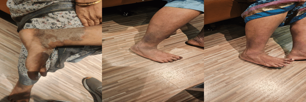 Psoriasis_Case_Before_Progress_Remission by Cure4Pain Mumbai India