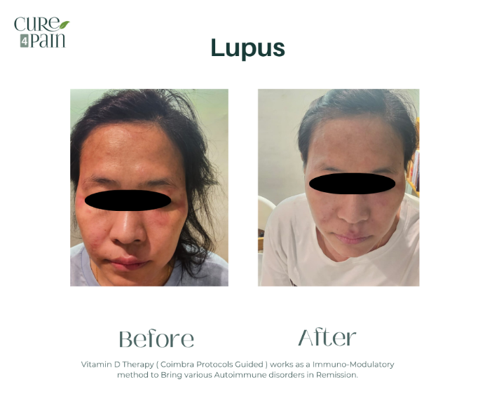 Lupus Before and After Treatment in India by Cure4Pain