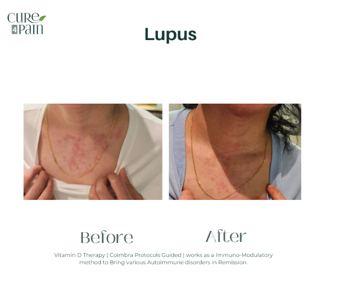 Lupus Before and After Treatment in Mumbai India by Cure4Pain Clinic in Mumbai