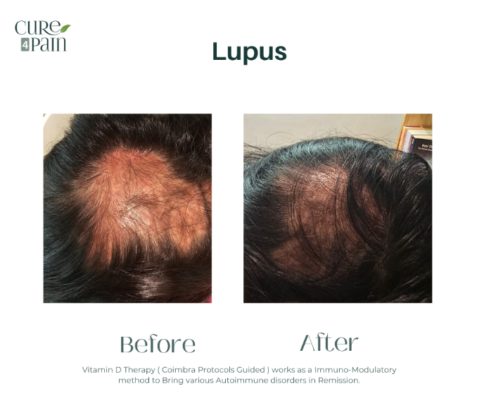 Lupus Before and After Treatment in Mumbai by Cure4Pain